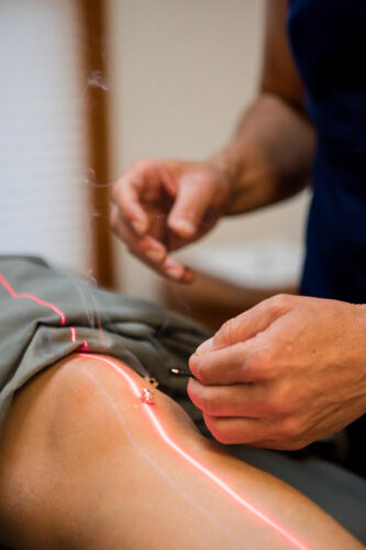Providing knee support using laser and moxibustion.